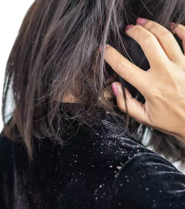 Women Suffering From Dandruff