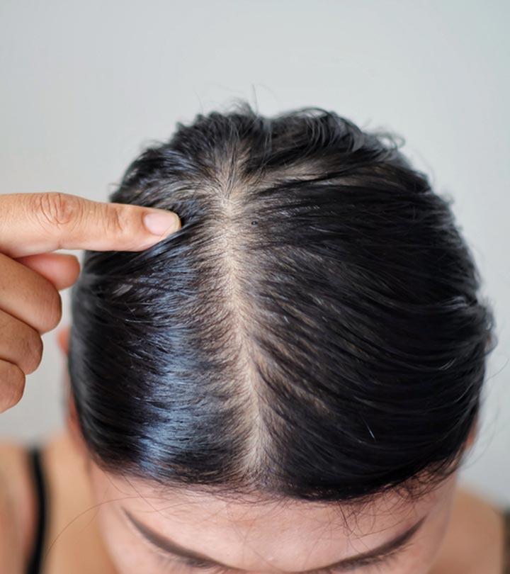 Oily Scalp Hair Loss Causes Symptoms and Prevention HS India