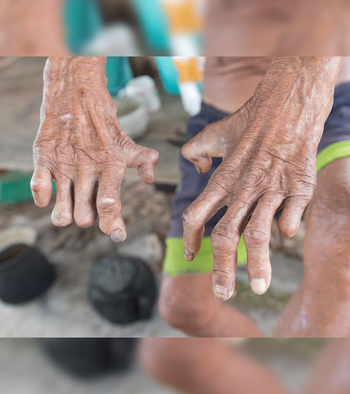 কুষ্ঠ রোগের কারণ, লক্ষণ এবং চিকিৎসা – Leprosy Causes, Symptoms and Treatment in Bengali