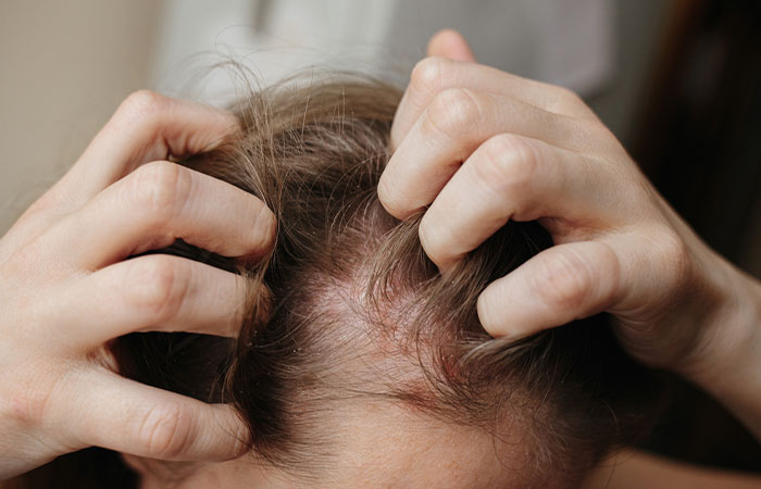 Close up of inflammation on woman's scalp