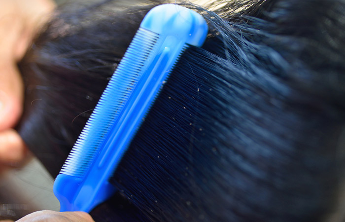 Close up of lice eggs as a lice comb is run through the hair