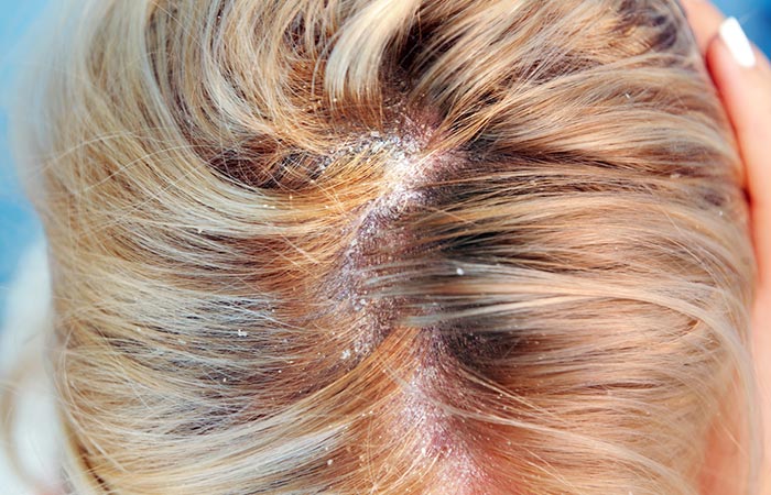 Close up of white flakes on scalp and hair.