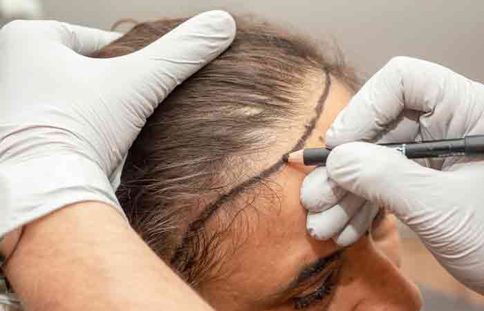Woman undergoing hair transplant to treat hair loss