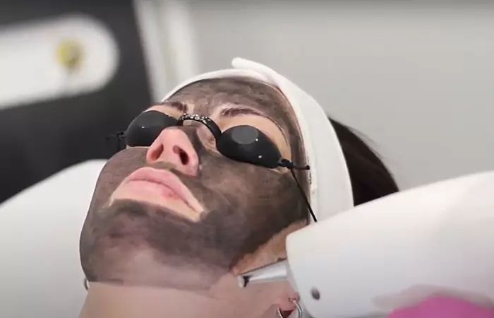 Carbon laser peel facial step 4