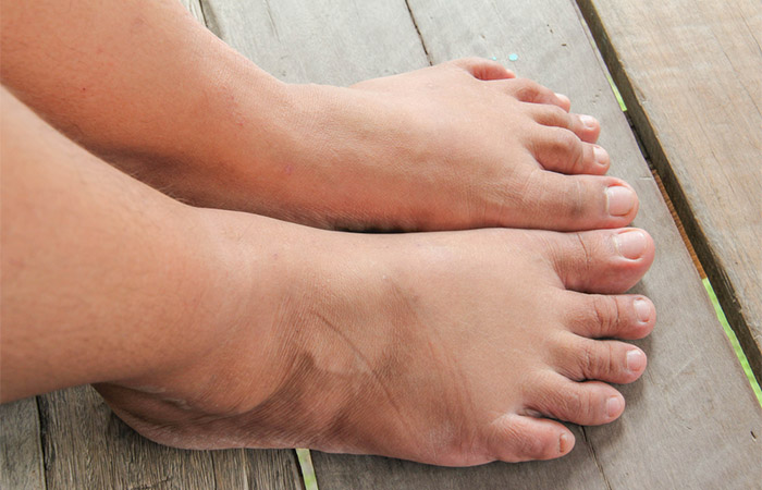 Woman with swollen feet due to dairy allergy