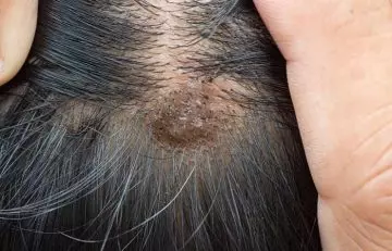 Atopic dermatitis inflammtory scalp problem