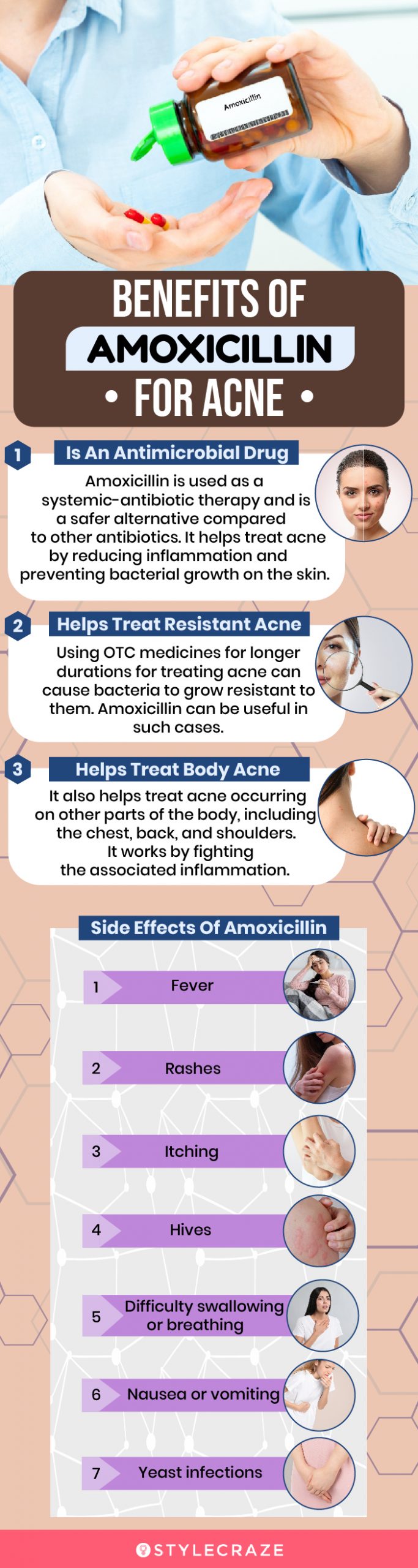 benefits of amoxicillin for acne (infographic)