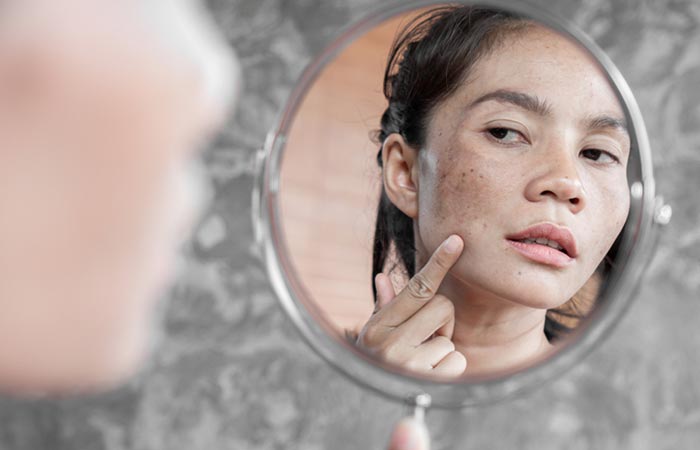 Bio-oil may reduce dark spots on the face