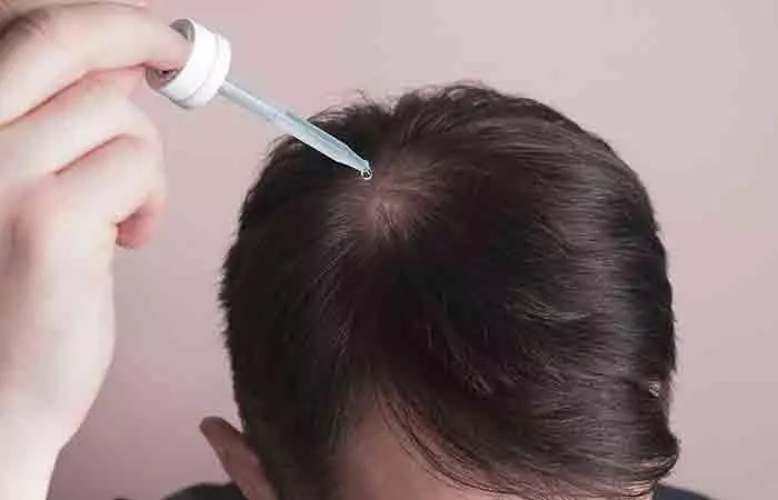 Minoxidil for hair thinning