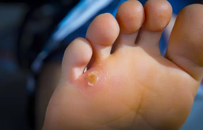 Woman with corns or dead skin on feet