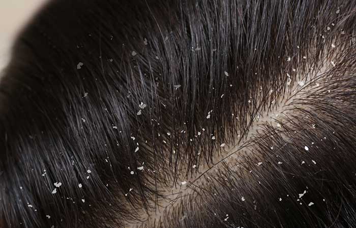 Dandruff and flaky scalp problem