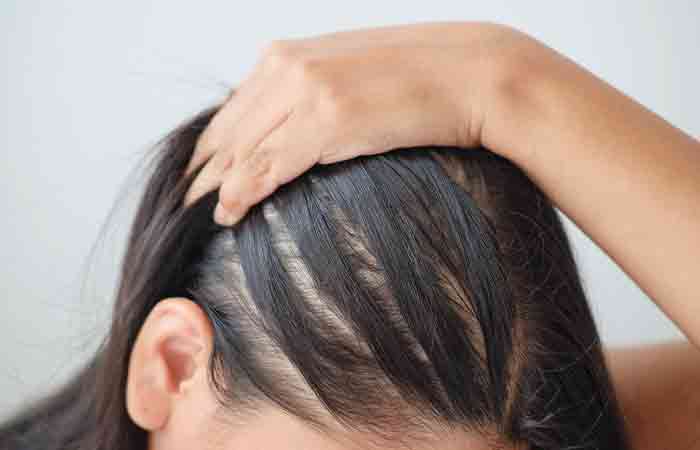 Accutane causes temporary hair loss.
