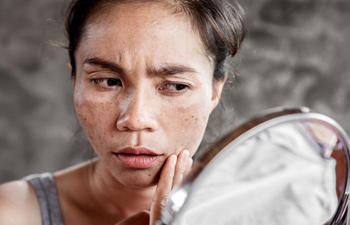 Woman checking acne in the mirror