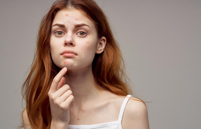 Woman with acne may benefit from mandelic acid