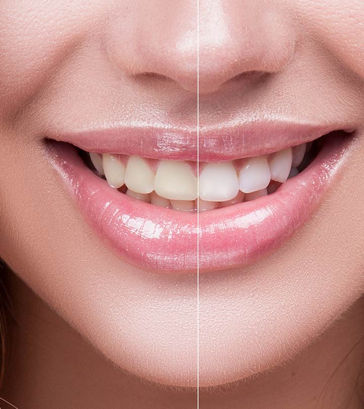 ঘরোয়া পদ্ধতিতে দাঁত সাদা রাখার কতগুলি উপায় | Home Remedies for Teeth Whitening