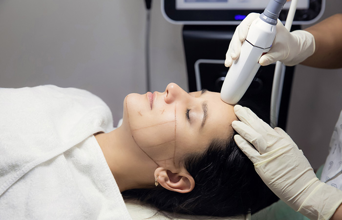 Woman getting laser treatment to get rid of baby hairs