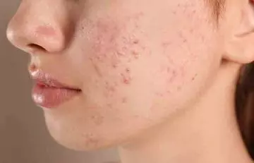 Closeup of acne on the face of a woman