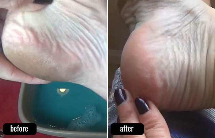Listerine Foot Soak Before And After Pictures-1
