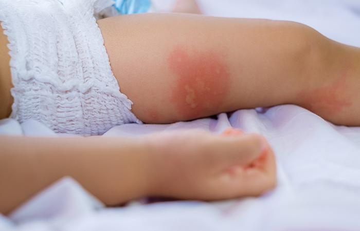 Baby with diaper rash may benefit from an oatmeal bath