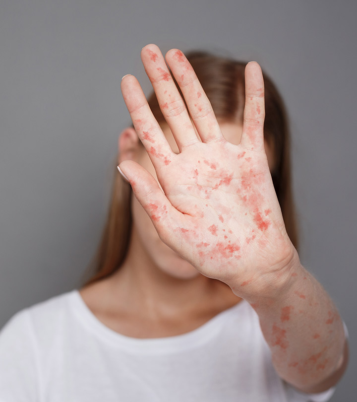 হামের (মিসেলস) কারণ, লক্ষণ বা উপসর্গ এবং চিকিৎসা পদ্ধতি | Measles Symptoms and Treatment