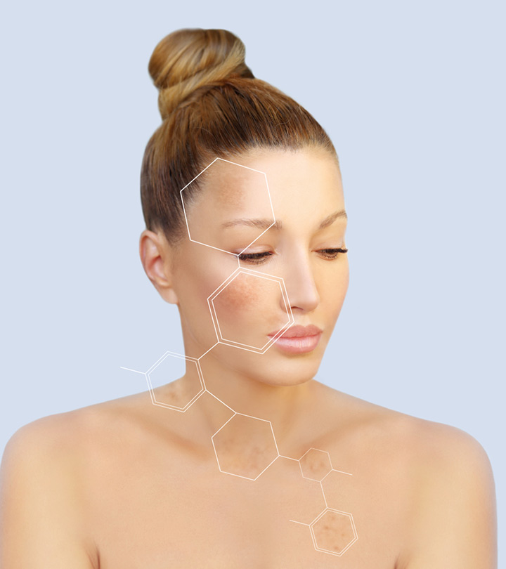 Melasma: What Is It, Causes, And Treatment Options