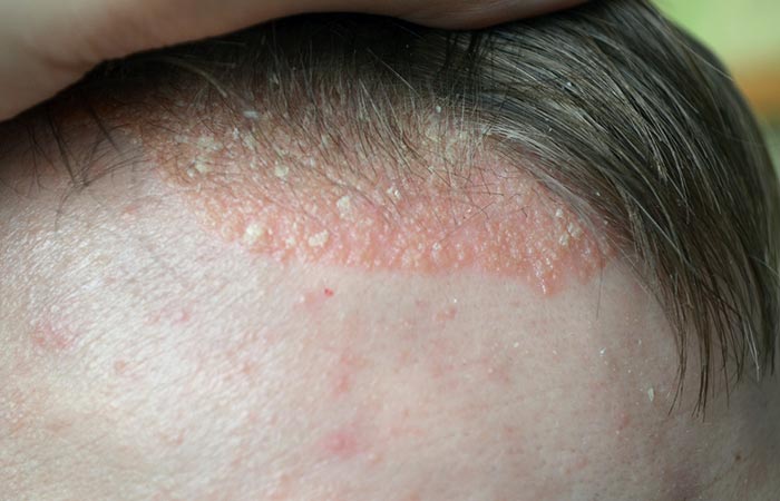 Psoriasis chronic scalp problem