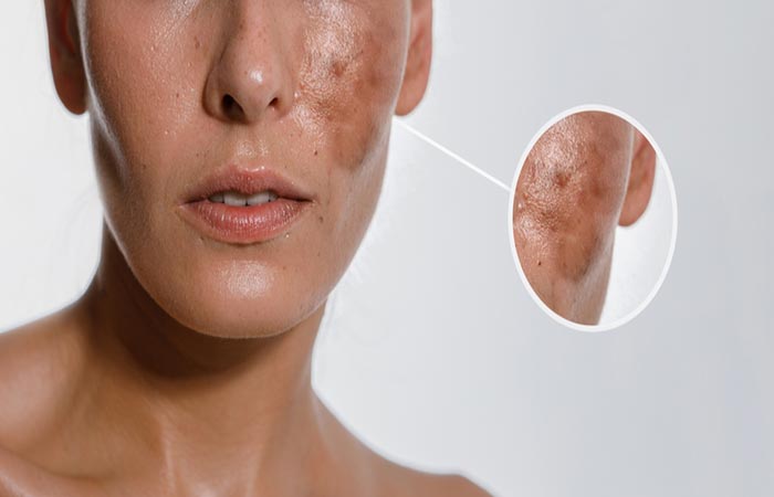 Woman with hyperpigmentation may benefit from mandelic acid
