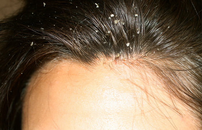 Woman with product buildup on scalp may benefit from clarifying shampoo 