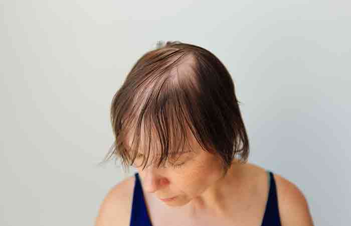 Bald patches in females due to genetic hair loss