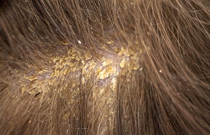 Yellow flakes on scalp
