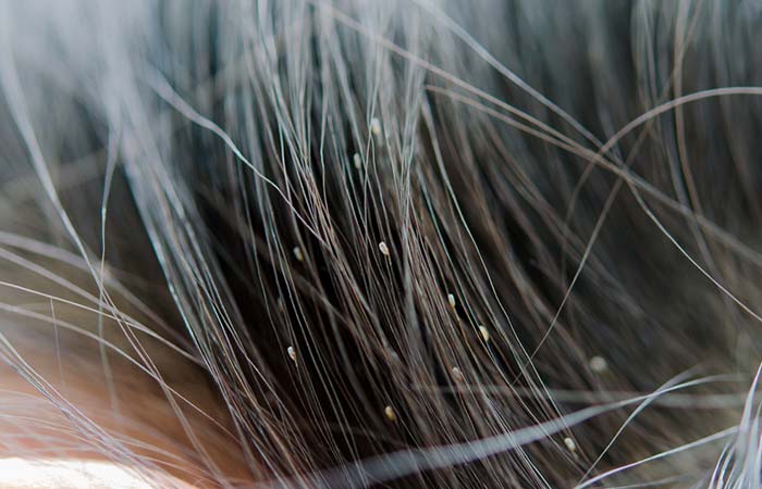 Signs of head lice infestion