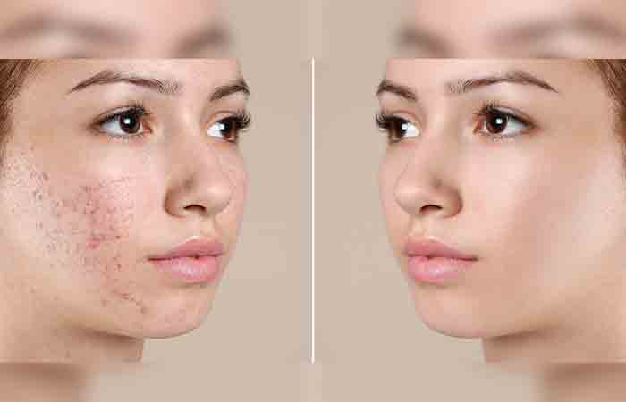 Before and after pictures of treating acne with amoxicillin