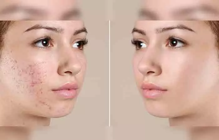 Before and after pictures of treating acne with amoxicillin