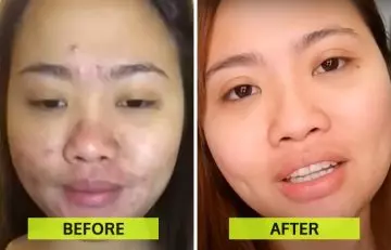 Carbon laser peel facial before and after results 1