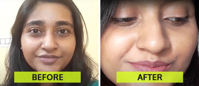 Carbon laser peel facial before and after results 2