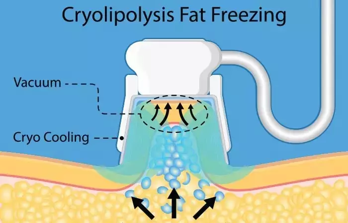 What Is A Fat Freezing (CoolSculpting) Machine