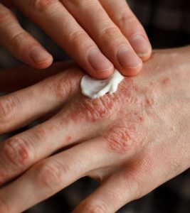 What is Psoriasis, Causes, Symptoms and Home Remedies
