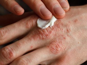 What is Psoriasis, Causes, Symptoms and Home Remedies
