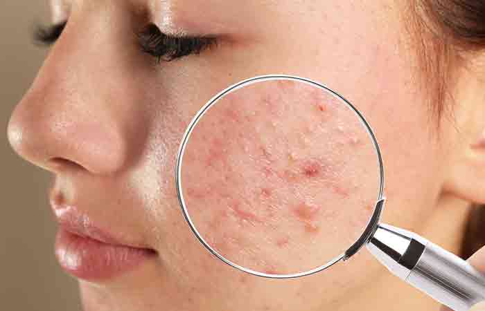 Use Neosporin when you have infected acne