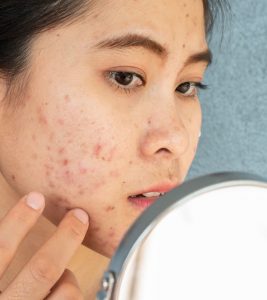 All You Need To Know About Fungal Acne