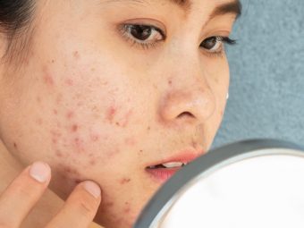 All You Need To Know About Fungal Acne