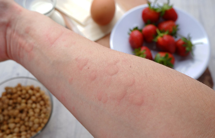 Woman with hives on hand due to ulcerative colitis medication