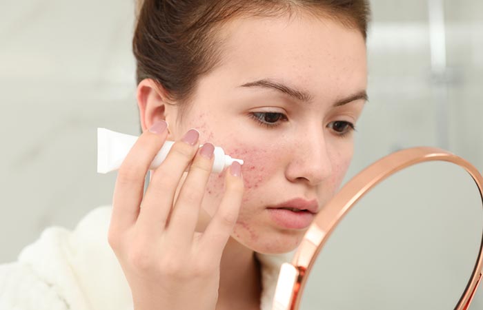 Woman uses an azelaic acid cream on her acne