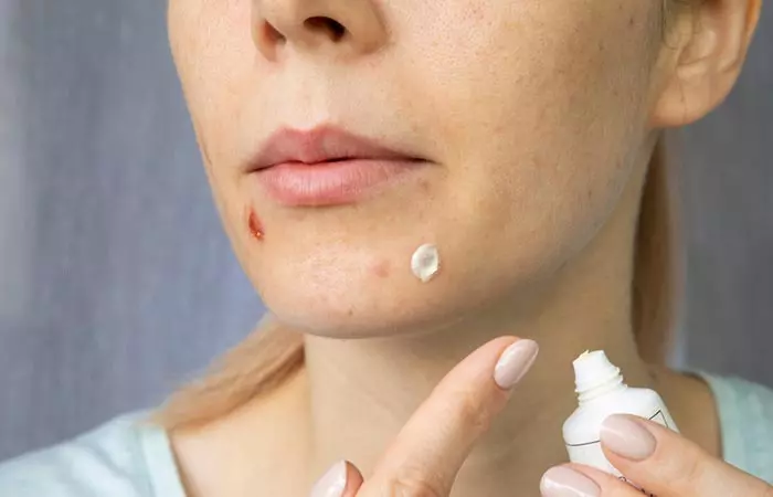 A woman applying Nizoral to the affected area