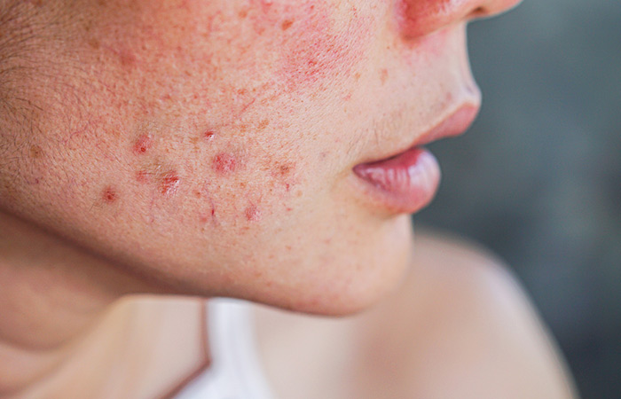 Woman with redness and inflammation caused by acne