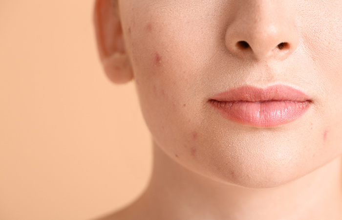Woman with acne may benefit from glycerin