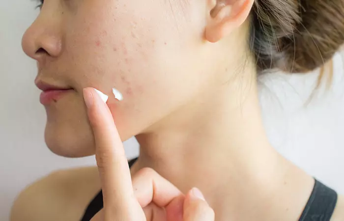 Woman with acne applying cream