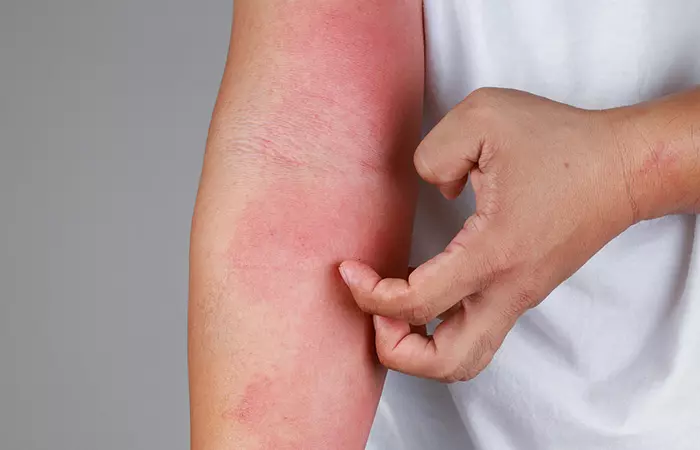 Person scratching allergies on their arm as a potential side effect of tea tree oil