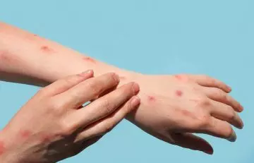 Application of glycerin may cause side effects like rashes