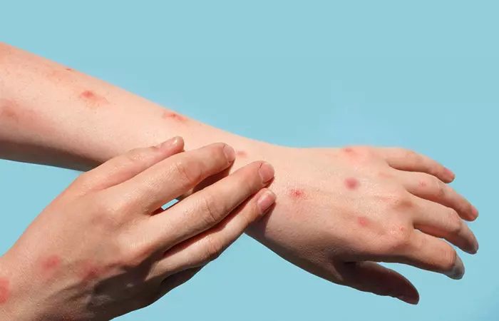 Application of glycerin may cause side effects like rashes